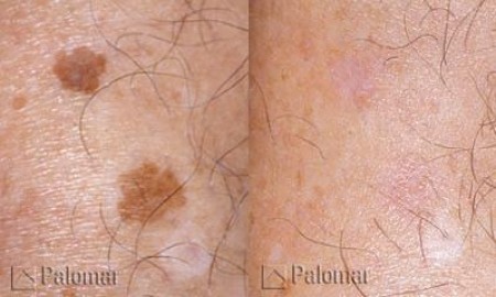 IPL-Before-and-After-31-e1286417268794