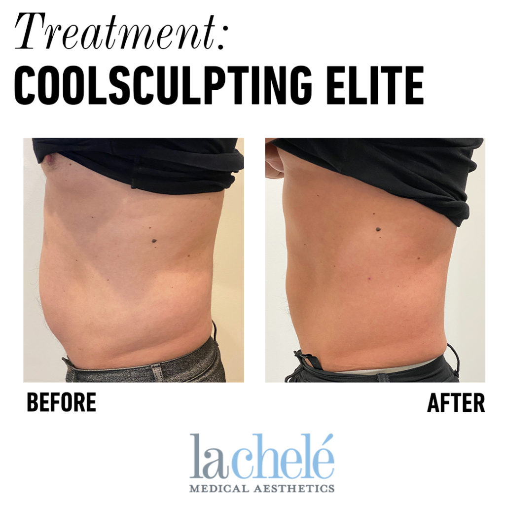 What is CoolSculpting Elite? - Bucks County, PA