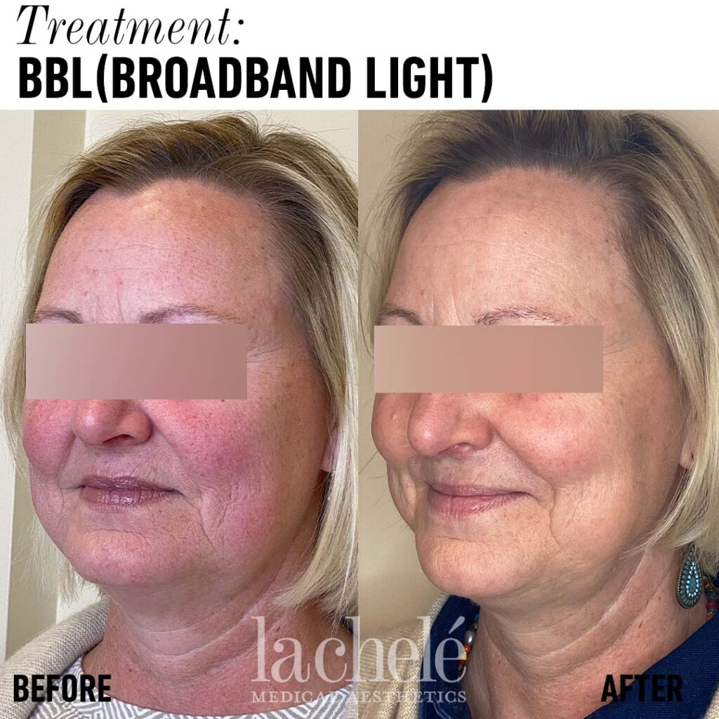 Forever Young BBL Laser Treatment - La Chele Medical Aesthetics, LLC