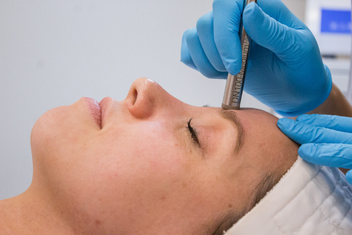 Microneedling Vs. Microdermabrasion La Chelé