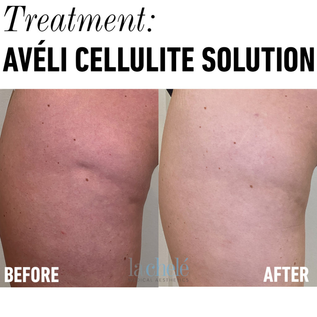 Comprehensive Guide To Avéli™ Long-Term Cellulite Treatment