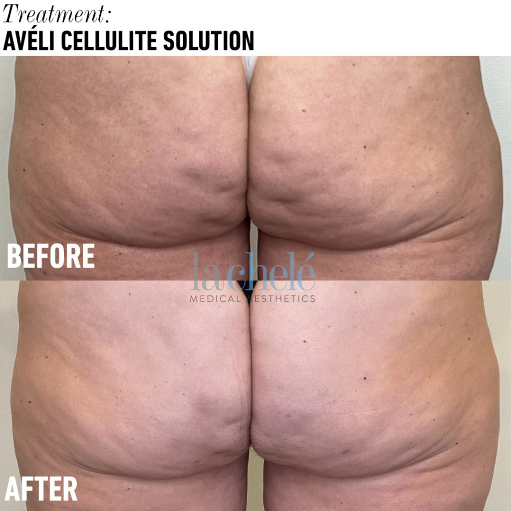Avéli Cellulite Solution - La Chele Medical Aesthetics, LLC