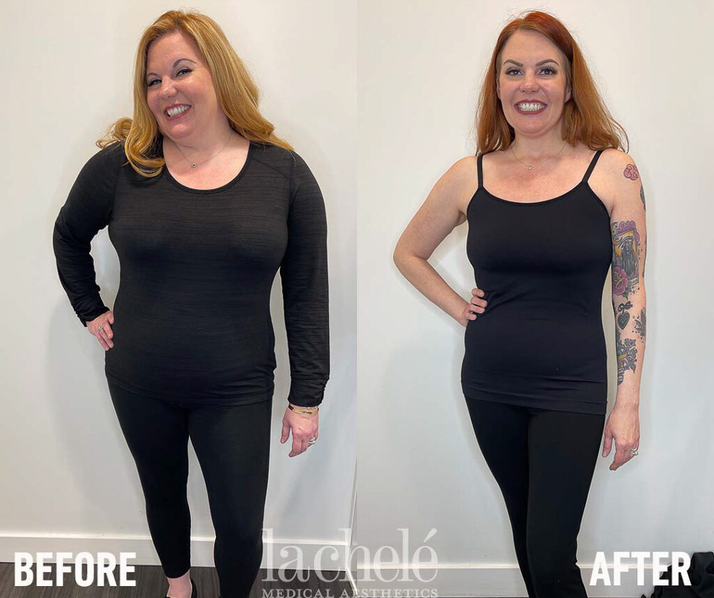 Ozempic for weight loss before and after