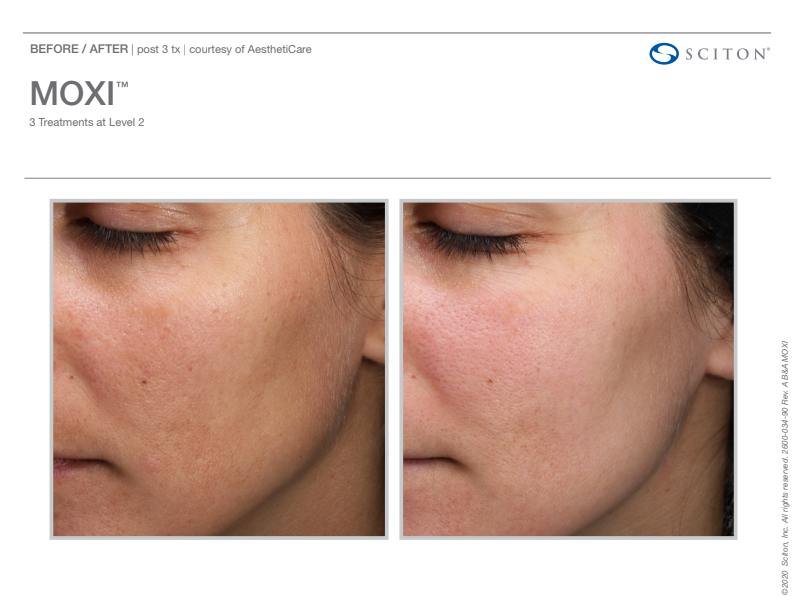 Before and after of Sciton Moxi Prejuvenation Laser