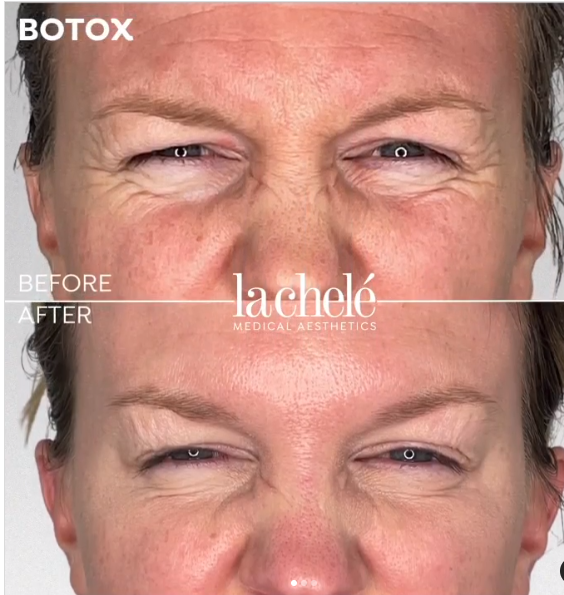 Before and after Botox crows feet