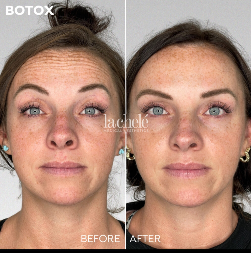 Before and after Botox forehead lines