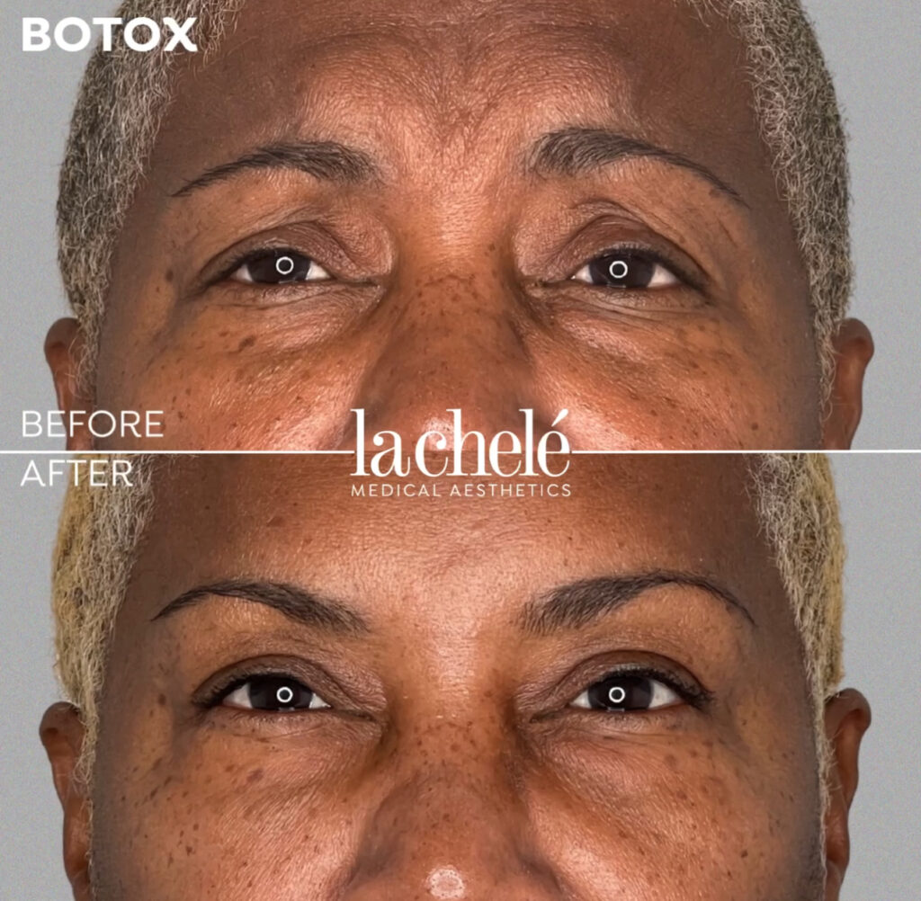 Before and after Botox lines between the brows