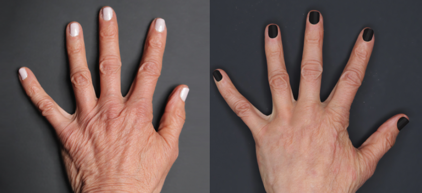 Renuva Hand Before and After