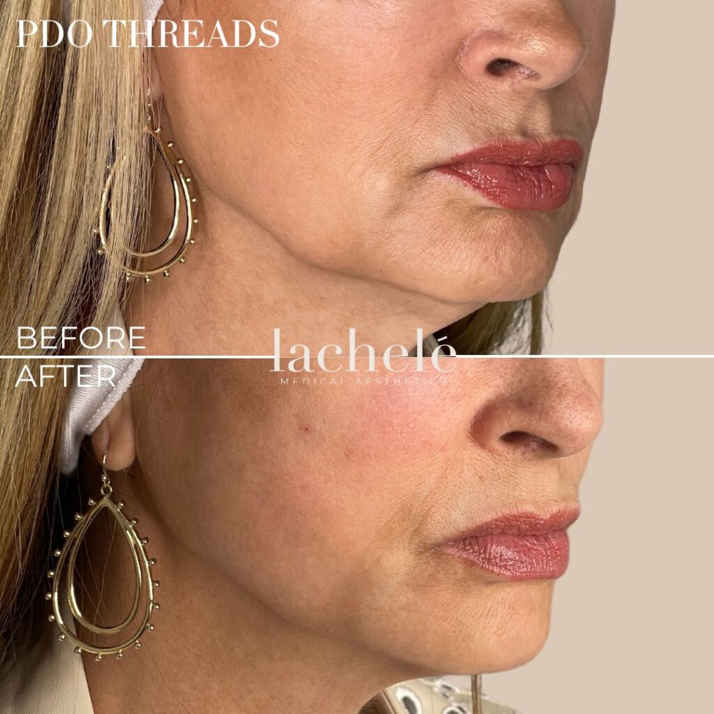 pdo threads before and after jowls