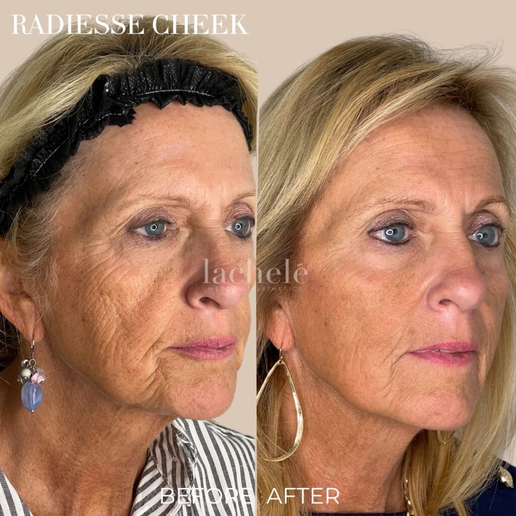 Radiesse Cheek Filler