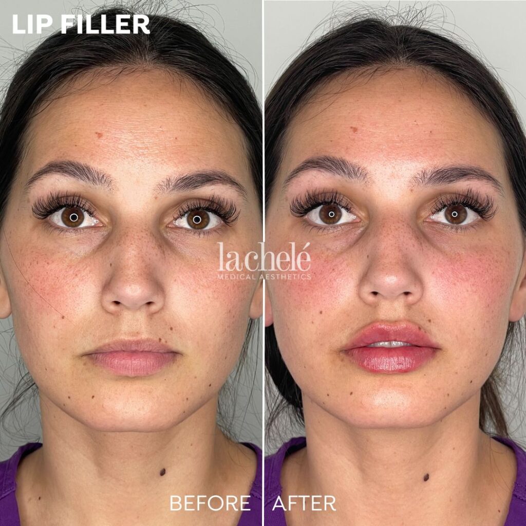 lip filler before and after