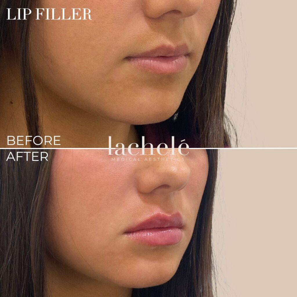 lip filler before and after