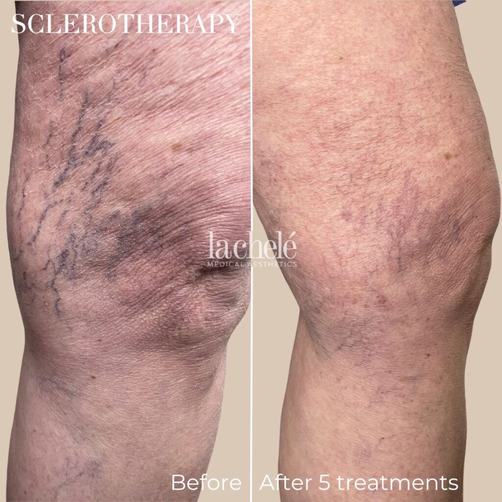 sclerotherapy before and after