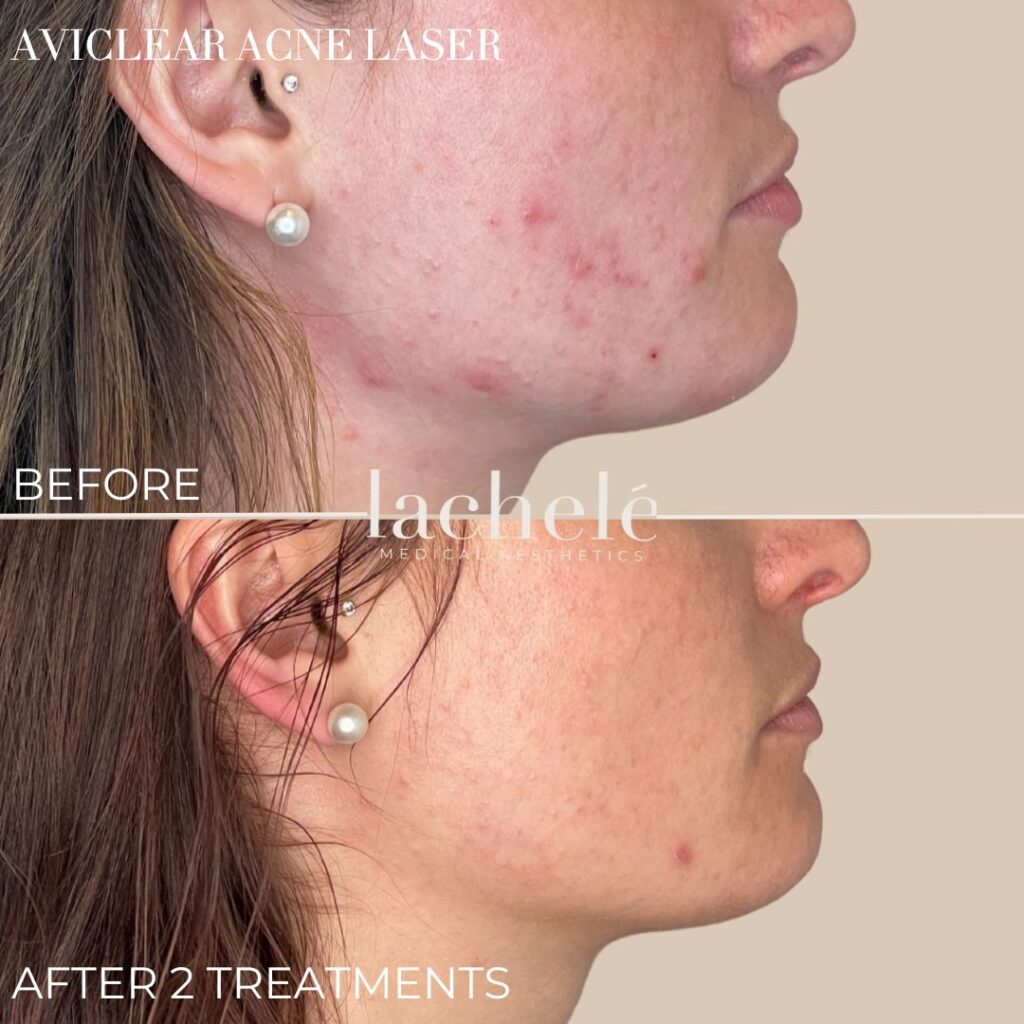 Aviclear Before and After