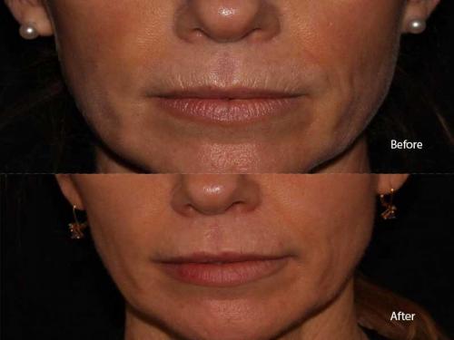 Lip line results with dermal filler injections